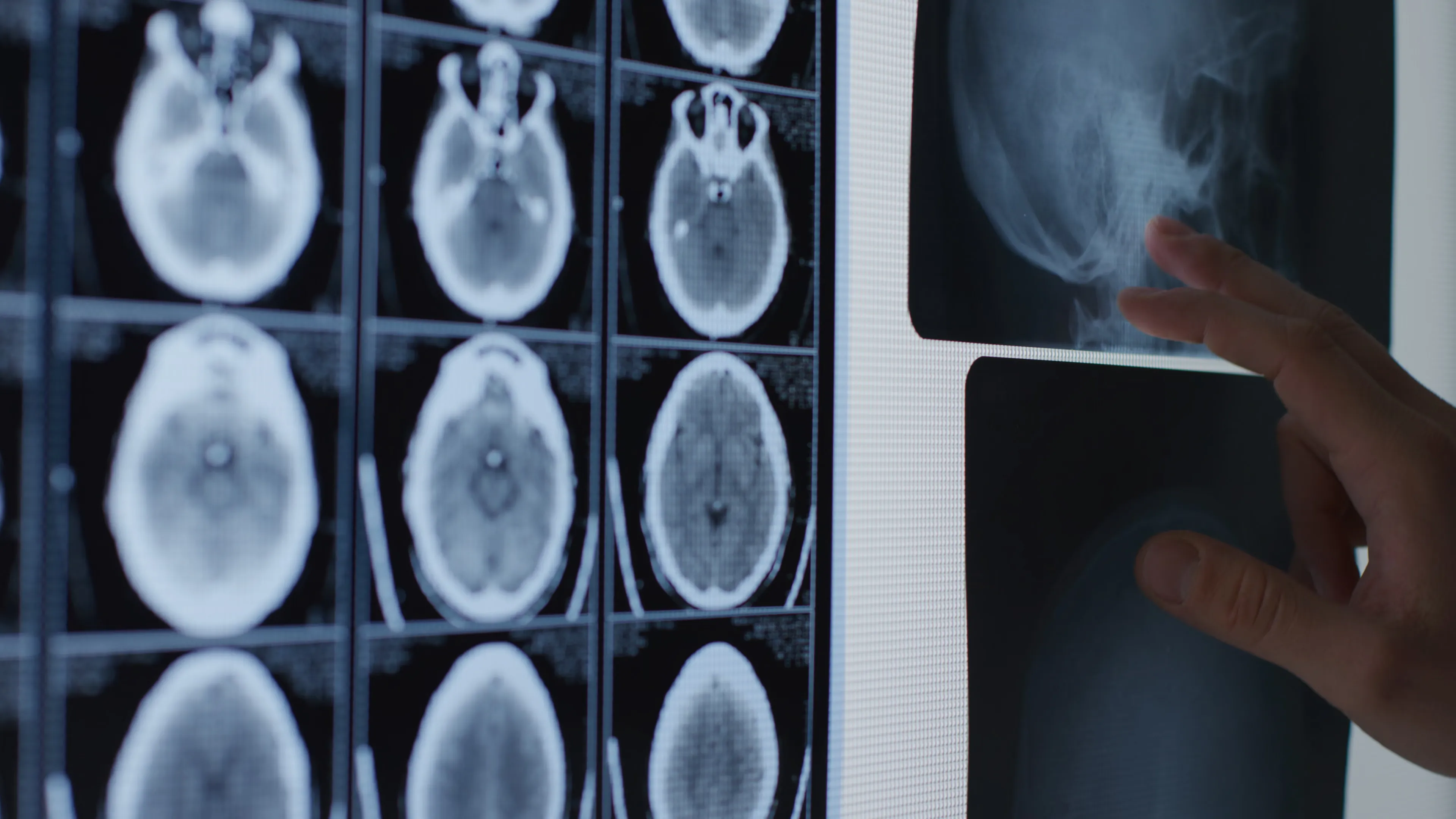 Clinician holding a sheet of CT brain scans up to the light
